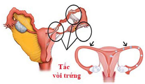 Tắc vòi trứng là một trong những bệnh phụ khoa hàng đầu gây ra vô sinh ở nữ giới